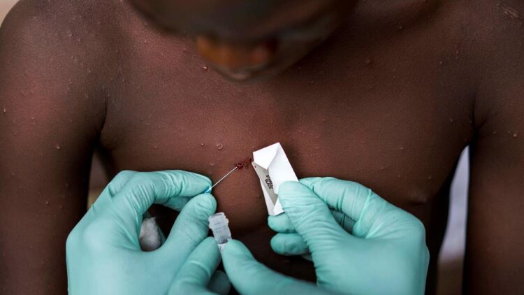 DGS confirma 14 casos de infeção humana por vírus Monkeypox em Portugal