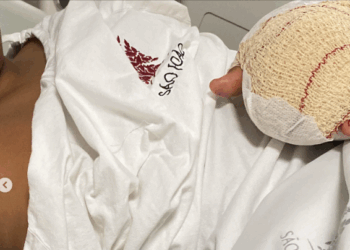 Região: Criança sofre amputação de dedos em episódio de bullying