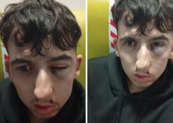 Seia: Jovem foi agredido em emboscada preparada por grupo de amigos